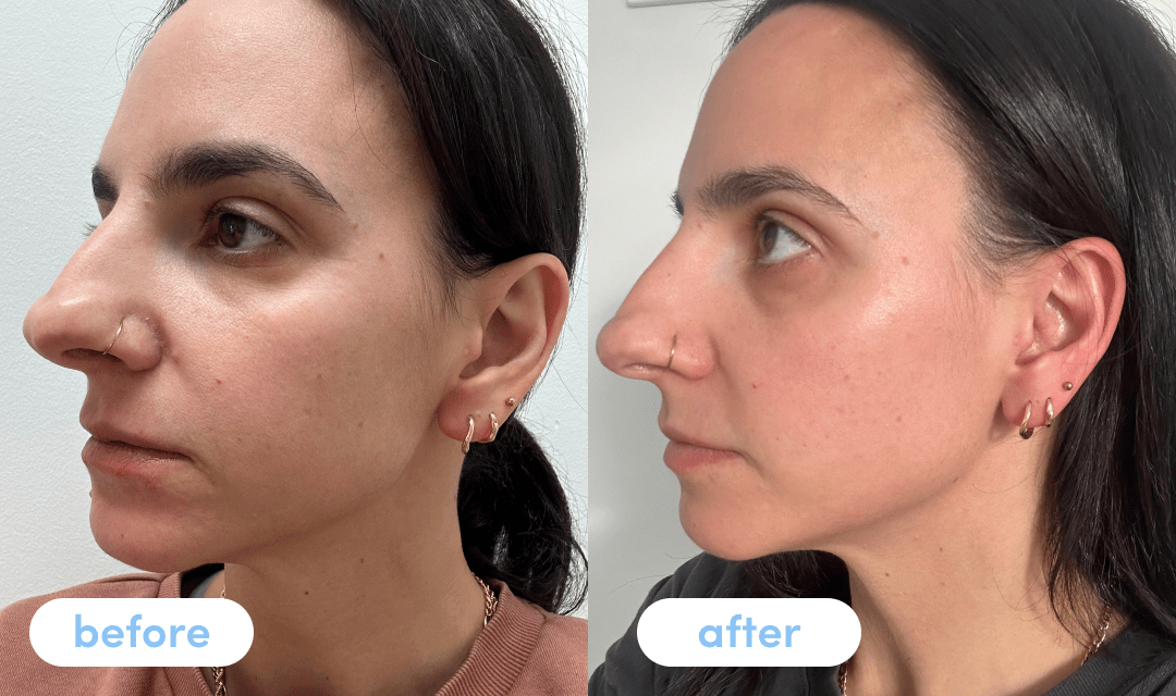 Elena M. - Taking Premium Collagen Peptides for 4 weeks The Collagen Co. Elena M. - Taking Premium Collagen Peptides for 4 weeks The Collagen Co.
