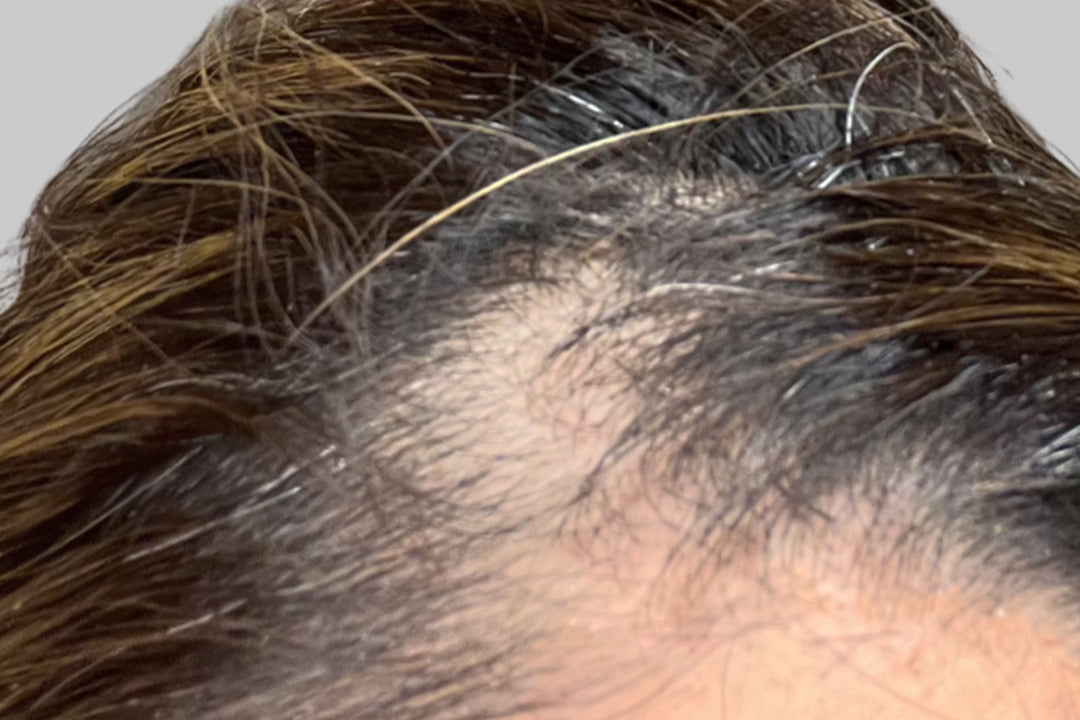Thinning hair close-up with visible scalp and hair strands. Focus on texture and color variation in hair.