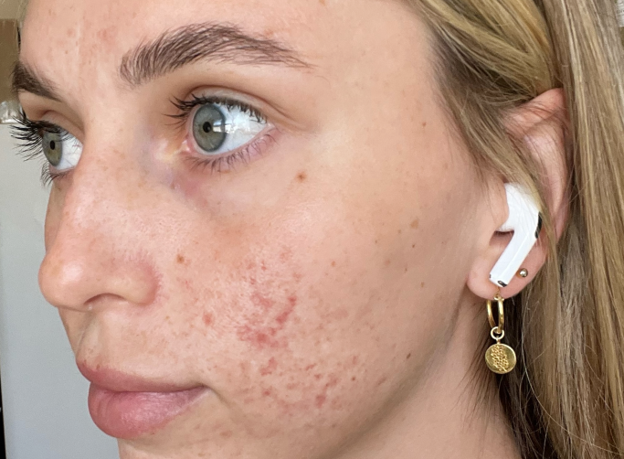 Close-up of a woman with acne scars on her cheek, wearing earbuds and a gold earring. Focus on skin texture and natural beauty.