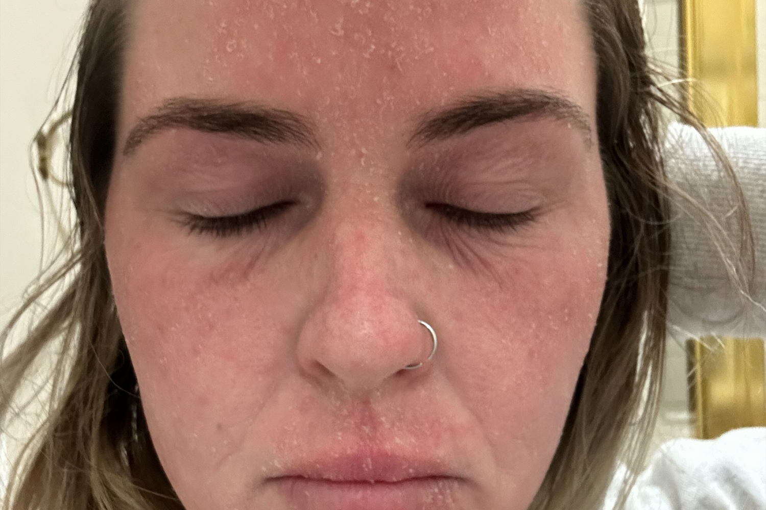 Close-up of a woman's face with closed eyes, showing dry, peeling skin. Focus is on skin texture, skincare needs, and potential collagen benefits.