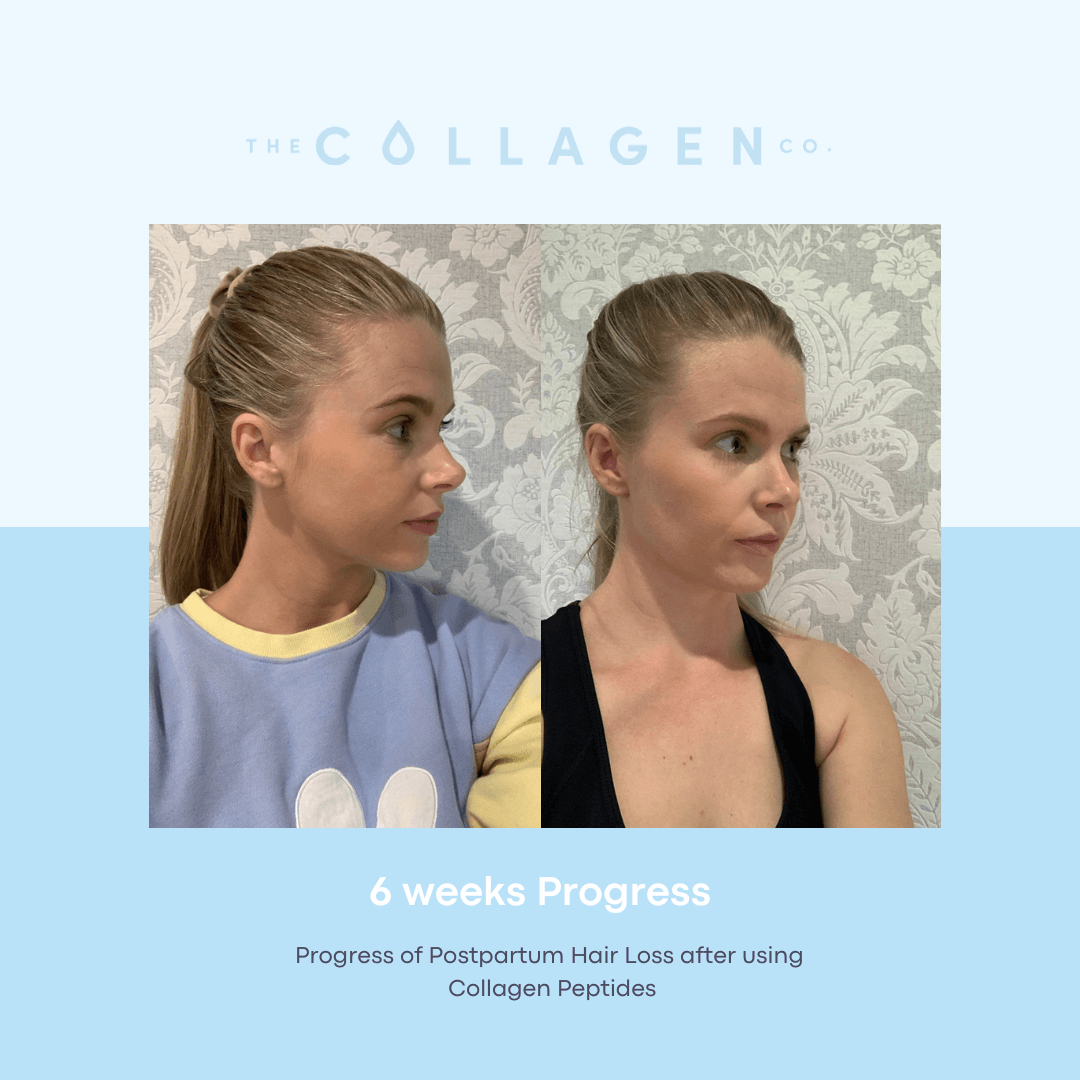 Becky Getting Through Postpartum Hair Loss By Taking Collagen - The Collagen Co.