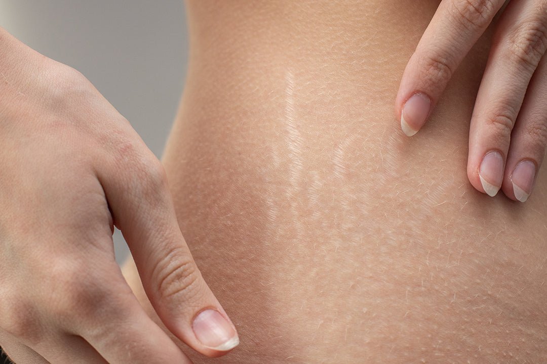 Does Collagen Reduce Stretch Marks? - The Collagen Co.