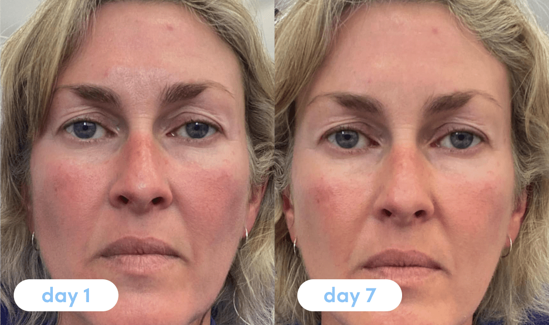 Heidi M. has been taking Premium Collagen for 7 days - The Collagen Co.