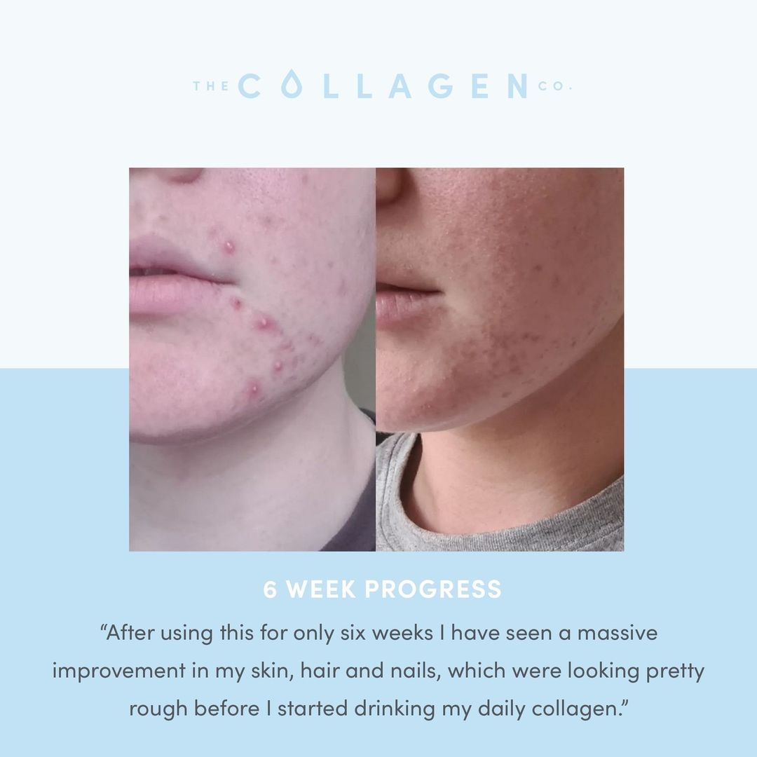 How Becky cleared up her acne without medication - The Collagen Co.