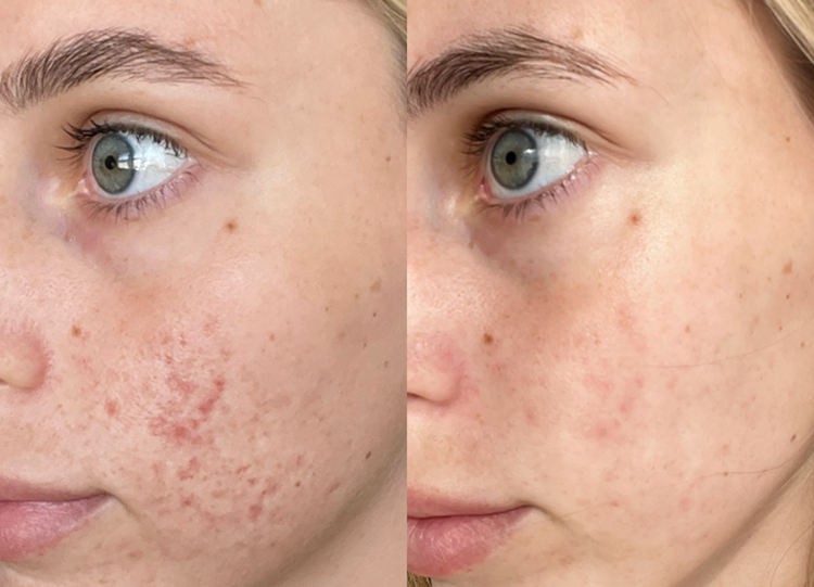 Foto comparativa de piel