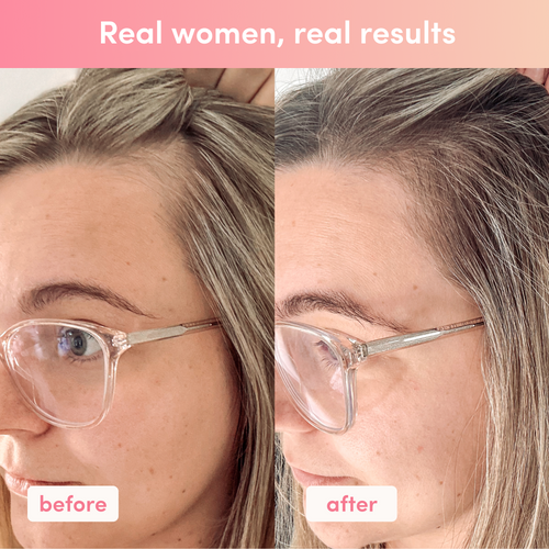 Side-by-side before-and-after images showing improved hairline on a woman wearing glasses, suggesting collagen use. Text reads "Real women, real results."