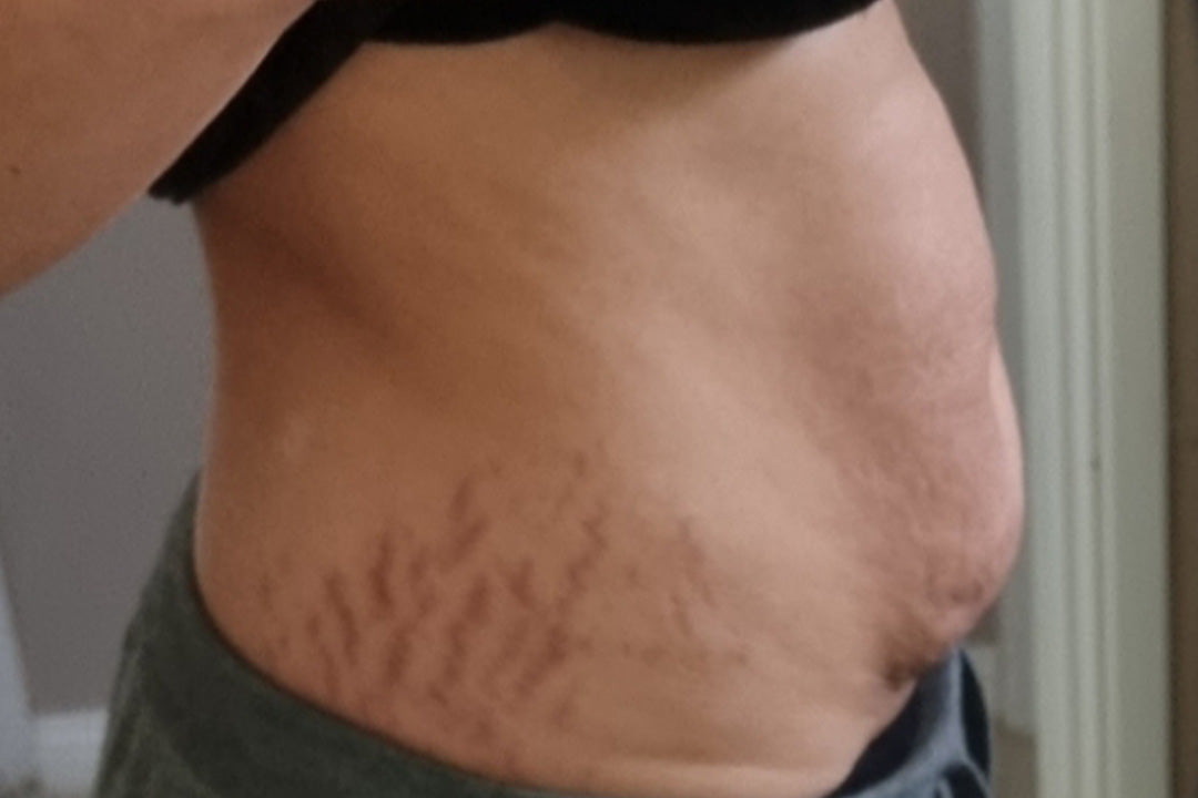 Side view of a person's abdomen with visible stretch marks. Skin appears textured, highlighting focus on beauty, skincare, and collagen supplements.