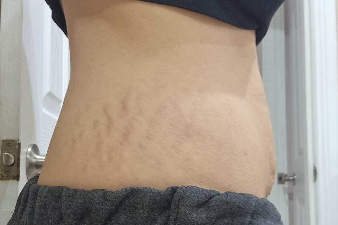 Close-up of a person's midsection with visible stretch marks on the skin. The focus is on the skin texture, highlighting natural beauty.