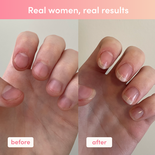 "Before and after images of fingernails show improvements in nail length and health, illustrating collagen supplement benefits. Text reads: 'Real women, real results.'"